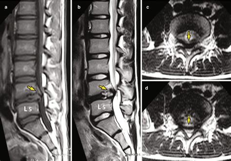 Pediatric Lumbar Disk Herniations Springerlink