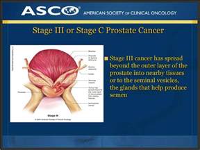 PPT PLWC Slide Deck Series Understanding Prostate Cancer PowerPoint