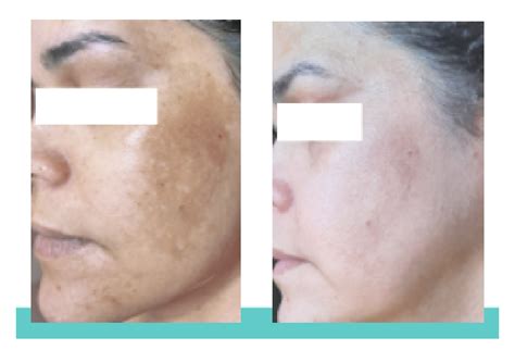 MELASMA CONFIRA O ANTES E DEPOIS DO TRATAMENTO Blog Ada Tina