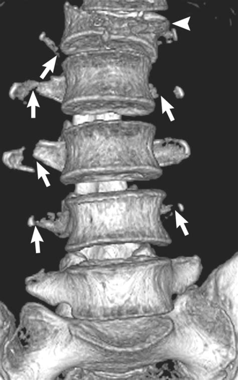 In A 50 Yr Old Man With Crush Fractures Of Transverse P Open I