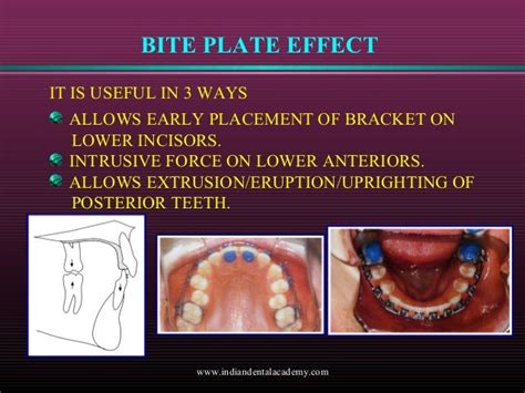 Levelling and aligning in orthodontics /certified fixed orthodontic c…