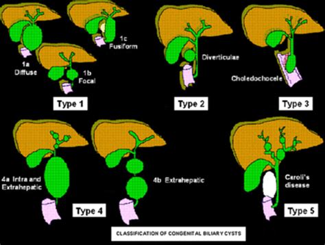 Choledochal Cyst Classification Used With Permission From Rozel Et Al Download Scientific