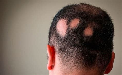 Alopecia Areata Causas Tratamiento y Solución Clínica Capilar