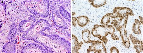 Squamous Cell Carcinoma Of The Urinary Bladder Showing Well Formed Download Scientific Diagram