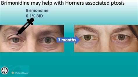 Horner Syndrome - Symptoms, Causes & Treatment - Santripty