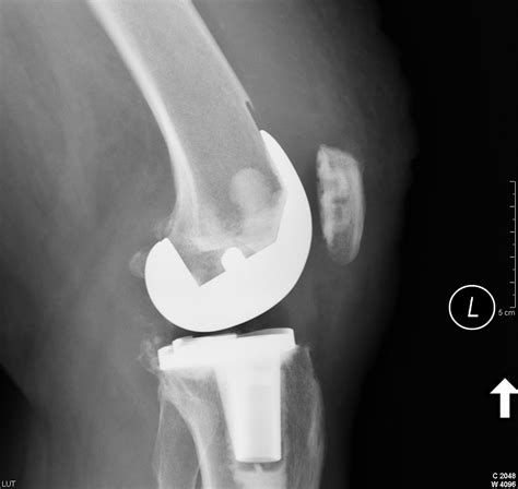 Outcome Of Periprosthetic Distal Femoral Fractures Following Knee Arthroplasty Injury