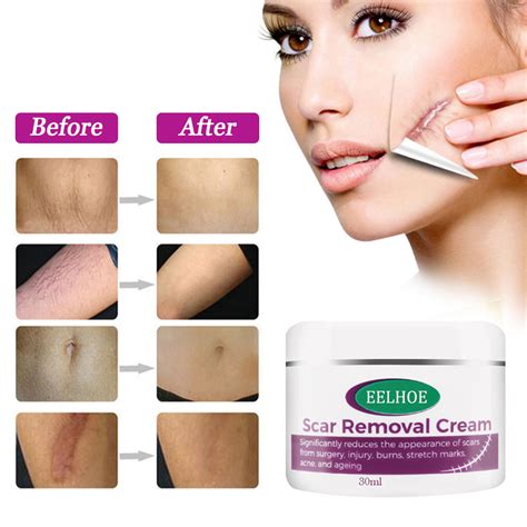 Bestope Scar Removal Cream For New And Old Scars Stretch Mark Removal