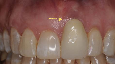 How To Prevent And Manage Black Lines Around Crowns And Gum Recession