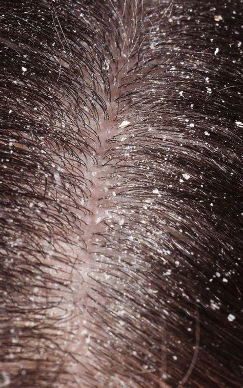 How to Treat Dandruff and Other Scalp Conditions - Revitalis