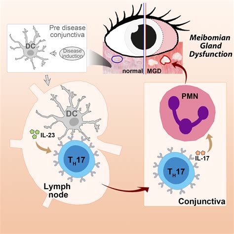 Immune Response Likely Culprit In Eyelid Gland Condition That Causes Dry Eye