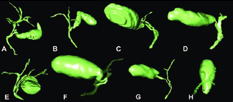 Virtual Reality Visualization Of Biliary Anatomical Variants A Case