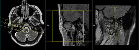 Temporomandibular Joints Tmjs Mri Planning And Protocols