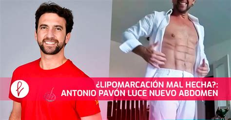 Noticia ¿lipomarcación Mal Hecha Antonio Pavón Luce Nuevo Abdomen