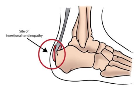 Surgery For Insertional Tendinopathy Mr Daniel Goldbloom Melbourne