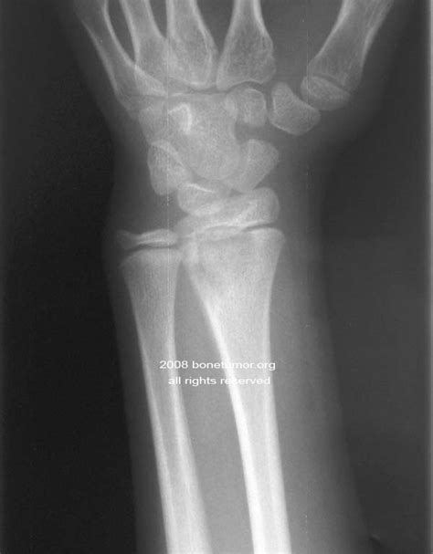 Chronic Recurrent Multifocal Osteomyelitis CRMO BoneTumor Org