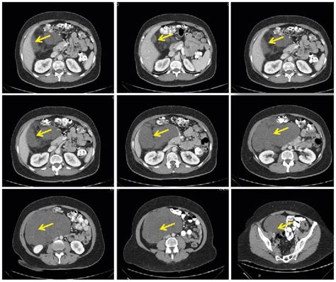 Figure From Dyspnea Caused By A Giant Retroperitoneal Liposarcoma A