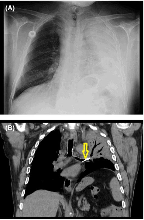 A Chest Radiograph At Admission Revealing A Heterogeneous Download Scientific Diagram