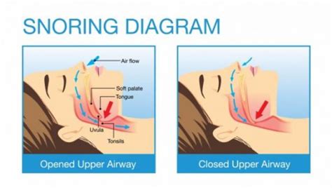 Can Snoring Damage The Upper Airways? – Snoring Devices Australia