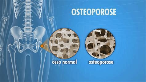 Entenda o que é e como prevenir a osteoporose DF1 G1