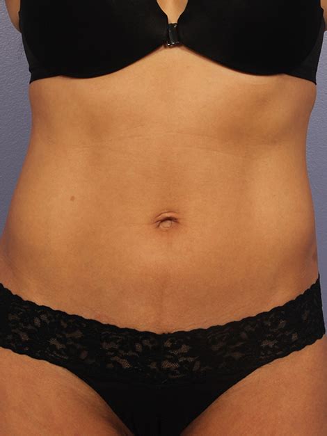 Los Angeles CoolSculpting Before And After Photos Beverly Hills