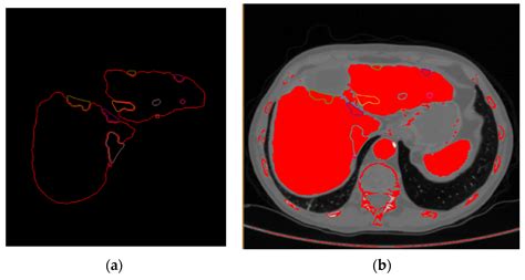 Livers Free Full Text Assisting Difficult Liver Operations Using 3d