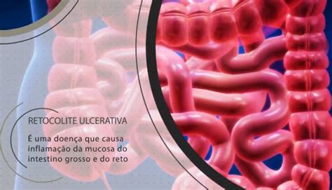 Voc Sabe O Que Retocolite Ulcerativa Portal Da Coloproctologia