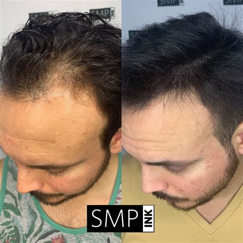 Scalp Micropigmentation Before and After Photos - SMP INK