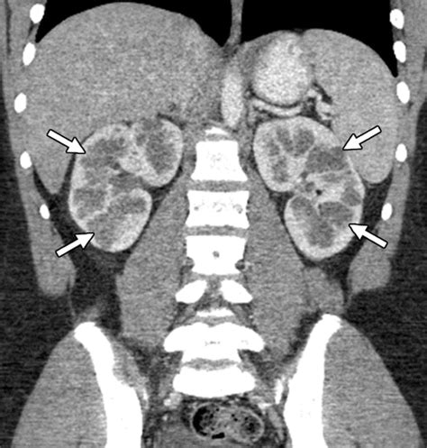 Hereditary Renal Cystic Disorders Imaging Of The Kidneys And Beyond