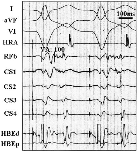 lateral ap  long retrograde conduction time  earliest atrial