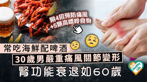 小心痛風︳30歲男常吃海鮮配啤酒 嚴重痛風關節變形 腎功能衰退如60歲︳附預防痛風4大貼士 晴報 健康 筋骨痛症 D230206