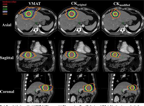 Figure 1 From Gated Volumetric Modulated Arc Therapy Vs Tumor Tracking Cyberknife Radiotherapy