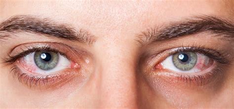 The 5 Most Common Eye Infections And How To Avoid Them