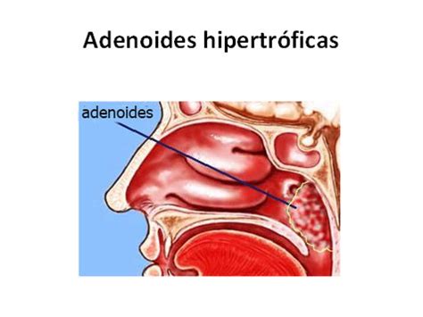 Pr Ctica Importante Registro Amigdalas Y Adenoides Anatomia Posicionar