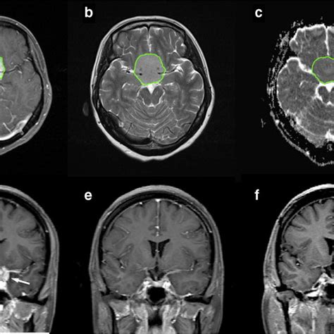 A Year Old Woman With Pathologically Proven Sellar Meningioma Who