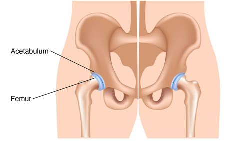 Hip Dysplasia Healthdirect