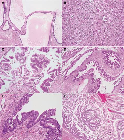 Ovarian Torsion Histology