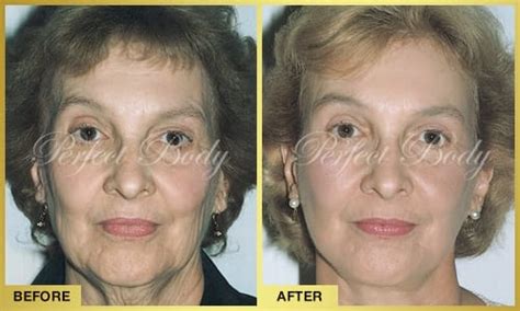 Skin Tightening Gallery Perfect Body Laser Aesthetics Long