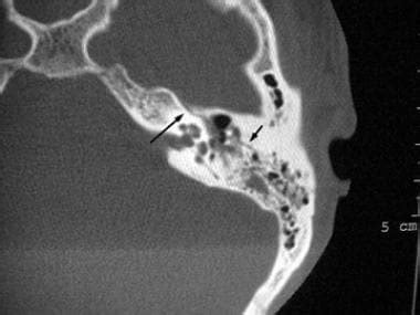 Temporal Bone Fracture Types