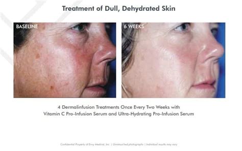 Dermal Infusion | Olivo Medspa - Chicago IL