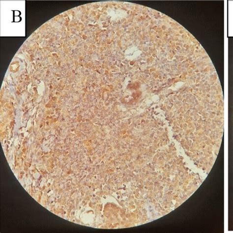 Immunohistochemistry Staining For IDH1 R132H Expression In Laryngeal