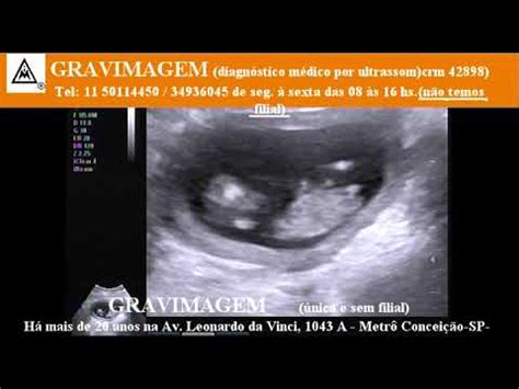 Gravimagem Ultrassom Morfol Gico Em Gravidez Semanas Mp Youtube