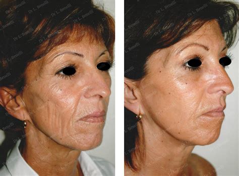 Photos avant après de chirurgie esthétique du visage