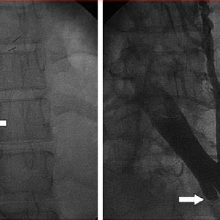 Panel A Venography Showed Extensive Thrombosis In Ivc With A