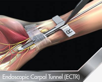 Endoscopic Carpal Tunnel Release