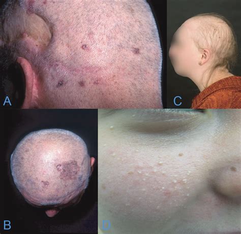 A B Patient With Gorlin Goltz Syndrome And Multiple Basal Cell