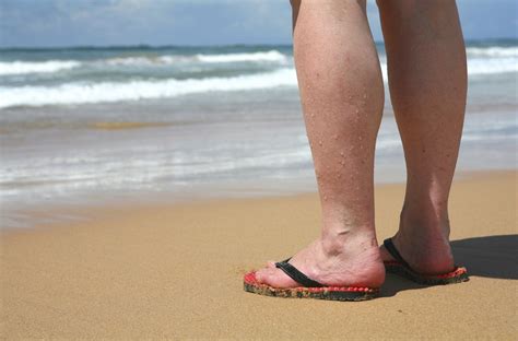 Varicose Veins One Of The Most Commonly Ignored Conditions Vein