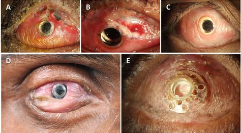 Keratoprosthesis