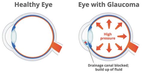 Glaucoma Treatment Toronto Glaucoma North York Ontario