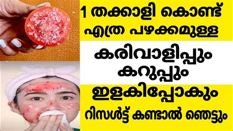 എളുപ്പത്തിൽ തന്നെ കരിവാളിപ്പ് മാറ്റിയെടുക്കാൻ ഈ രീതിയിൽ ചെയ്താൽ മതി