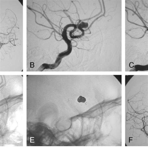 A Digital Subtraction Angiography DSA Anteroposterior Projection